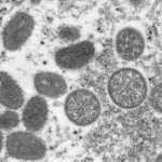 Citing racism and stigmatization concerns, the World Health Organization renames the rare viral disease as “Mpox”